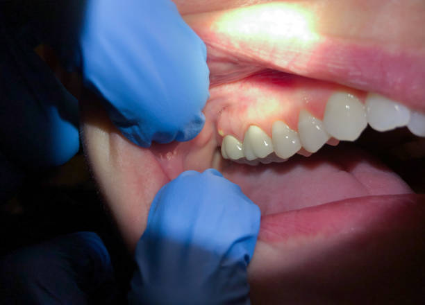 Best Emergency Dental Care for Sports Injuries in Fort Pierre, SD