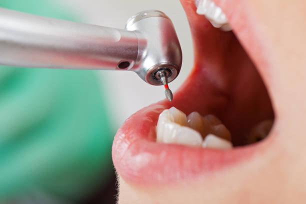 Best Knocked-Out Tooth (Avulsed Tooth) Treatment in Fort Pierre, SD